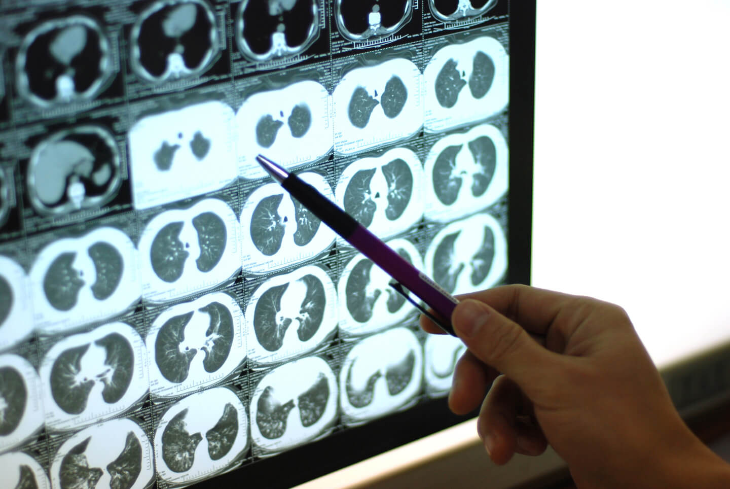 Auswertung von CT-scans